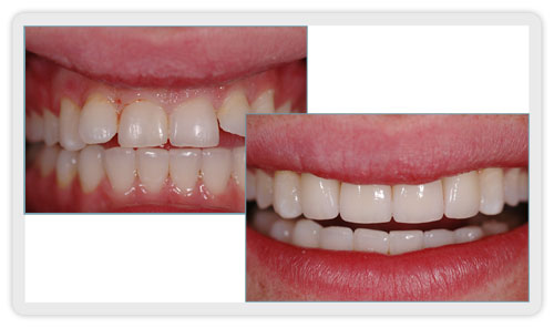 Dental Crowns Mississauga