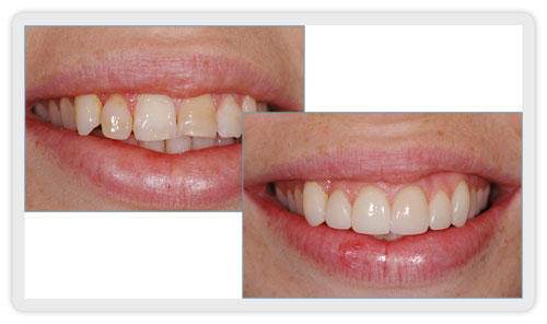 Dental Crowns Mississauga