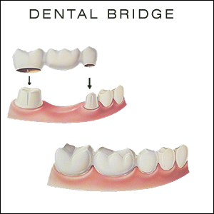 Dental bridges at Mississauga dental office