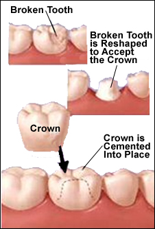 Dental Crowns Mississauga